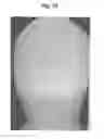 Fig. 53 - X-ray radiographic apparatus, method of measuring head tilt in taking radiograph, stand for X-ray radiographic apparatus, chair for X-ray radiographic apparatus, and head tilt setting device