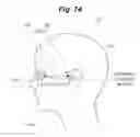 Fig. 75 - X-ray radiographic apparatus, method of measuring head tilt in taking radiograph, stand for X-ray radiographic apparatus, chair for X-ray radiographic apparatus, and head tilt setting device