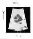 Fig. 12 - Ultrasonic diagnosis apparatus, image processing apparatus, and image processing method for tissue displacement caused by a shearwave generated by acoustic radiation force