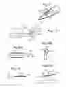 Fig. 11 - Vessel harvester