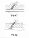 Fig. 06 - Methods for sealing a vascular puncture