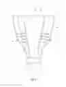 Fig. 07 - Spinal device comprising means of reversible fastening