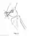 Fig. 06 - Internal joint bracing system and suture anchoring assembly therefore