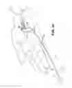 Fig. 08 - METHOD AND APPARTUS FOR REPAIRING A TENDON OR LIGAMENT