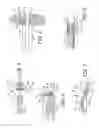 Fig. 03 - Methods and devices for the treatment of aneurysms