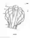 Fig. 43 - Tissue displacement tools and methods