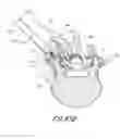 Fig. 79 - Vertebral facet joint drill and method of use