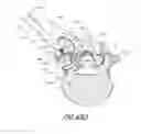 Fig. 81 - Vertebral facet joint drill and method of use