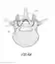Fig. 82 - Vertebral facet joint drill and method of use