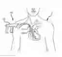 Fig. 01 - Multiple configuration surgical cutting device