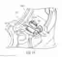 Fig. 35 - ULTRASONIC AND ELECTROSURGICAL DEVICES