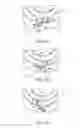 Fig. 34 - ULTRASONIC AND ELECTROSURGICAL DEVICES