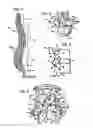 Fig. 02 - Crossbar spinal prosthesis having a modular design and related implantation methods