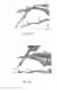 Fig. 08 - HAMMERTOE IMPLANT
