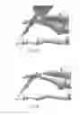 Fig. 09 - HAMMERTOE IMPLANT