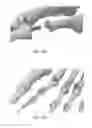 Fig. 10 - HAMMERTOE IMPLANT