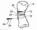 Fig. 01 - Devices, systems and methods for re-alignment of bone