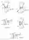 Fig. 04 - Devices, systems and methods for re-alignment of bone