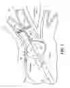 Fig. 08 - Real-time lesion formation assessment