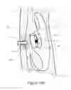 Fig. 24 - Apparatus and methods for treating rhinitis