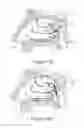 Fig. 25 - Apparatus and methods for treating rhinitis