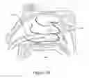 Fig. 44 - Apparatus and methods for treating rhinitis