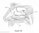Fig. 45 - Apparatus and methods for treating rhinitis