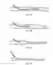 Fig. 04 - Endovascular plasma treatment device and method of use