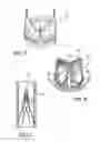 Fig. 05 - Method of making an endoprosthesis containing multi-phase stainless steel