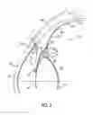 Fig. 03 - Method of reducing the occurrence of macular and neuroretinal degenerations by alleviating age related retinal stresses as a contributing factor in a mammalian eye