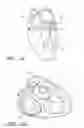 Fig. 02 - Device, system, and method for transcatheter treatment of valve regurgitation