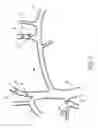 Fig. 02 - Methods and apparatus for treating neurovascular venous outflow obstruction