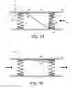 Fig. 04 - Methods and apparatus for treating neurovascular venous outflow obstruction