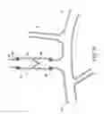 Fig. 16 - Methods and apparatus for treating neurovascular venous outflow obstruction