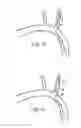 Fig. 22 - Methods and apparatus for treating neurovascular venous outflow obstruction