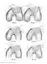 Fig. 07 - Extended patellofemoral