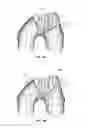 Fig. 08 - Extended patellofemoral