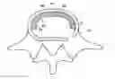 Fig. 01 - Method of in-situ formation of an intervertebral fusion device