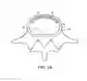 Fig. 03 - Method of in-situ formation of an intervertebral fusion device