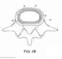 Fig. 04 - Method of in-situ formation of an intervertebral fusion device