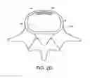 Fig. 06 - Method of in-situ formation of an intervertebral fusion device