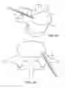 Fig. 09 - Method of in-situ formation of an intervertebral fusion device
