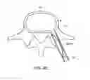 Fig. 16 - Method of in-situ formation of an intervertebral fusion device