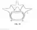 Fig. 28 - Method of in-situ formation of an intervertebral fusion device