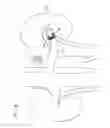 Fig. 17 - Prosthetic renal valve