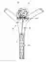 Fig. 01 - Vascular remodeling device
