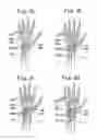 Fig. 04 - Hand joint supporter