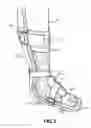Fig. 03 - Leg Brace and Walking Aid with Retractable Wheels