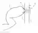 Fig. 01 - OSTOMY DEVICES