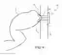 Fig. 06 - OSTOMY DEVICES